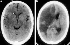 Neurology in Pratie *i8 Figure 1 CT brain san showing a right hemisphere total anterior irulation infart (A) at four hours, and (B) at five days after symptom onset.