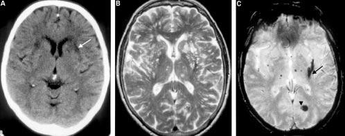 grey/white matter ortial differentiation (blak arrowheads), a little swelling with sulal effaement (blak arrow and ompare left side).