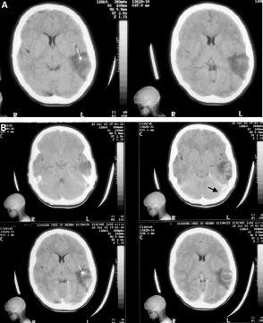 Neurology in Pratie Figure 3 Cerebral venous thrombosis and infartion (A) pre- and (B) post-intravenous ontrast. The sans were obtained at six hours after symptom onset.
