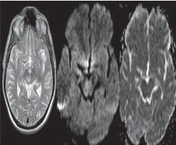High cellular tumors like malignant meningiomas / lymphoma / medulloblastoma and other tumors like epidermoid show restriction on diffusion weighted imaging with increased ADC values [14,15].