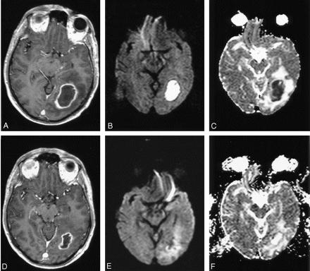 SUMMARY: Diffusion weighted imaging has a major role in the evaluation of acute stroke from chronic stroke and to differentiate between tumor infection and infarction.