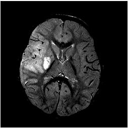 Suspected Stroke Emergent MRI with DWI/ADC Followed by