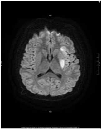 Patient X: History Part 2 Back to our 14 year old boy with a convulsion followed by right hemiparesis and aphasia Emergent MRI: small infarcts of L MCA territory MRA: mild narrowing of his left