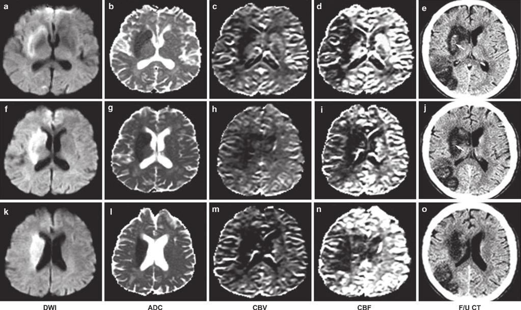 22 R. Forghani and P.W. Schaefer Fig. 2.10 (a o) Hemorrhagic transformation of an acute ischemic stroke in a 76-year-old man treated with intra-arterial tpa.