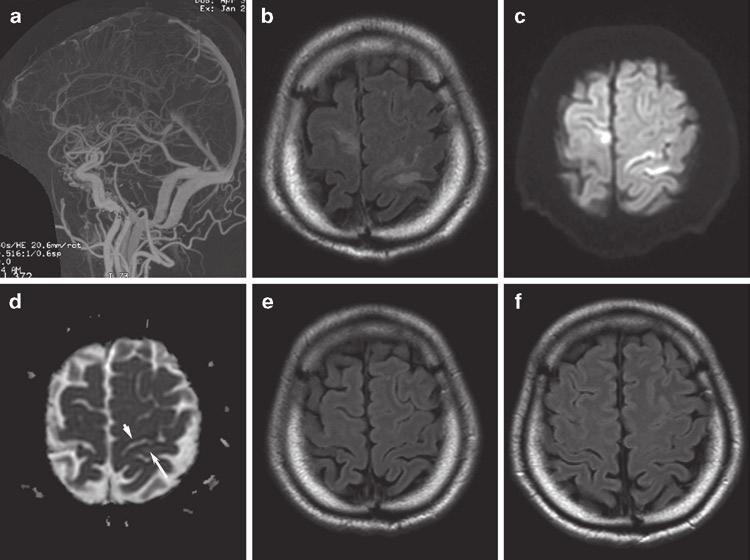 2 Clinical Applications of Diffusion 25 Fig. 2.11 Transient diffusion changes in cerebral venous sinus thrombosis.