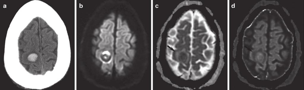 26 R. Forghani and P.W. Schaefer Fig. 2.12 Diffusion abnormalities associated with acute hemorrhage. (a) Axial unenhanced CT demonstrates an acute right superior frontal subcortical hematoma.