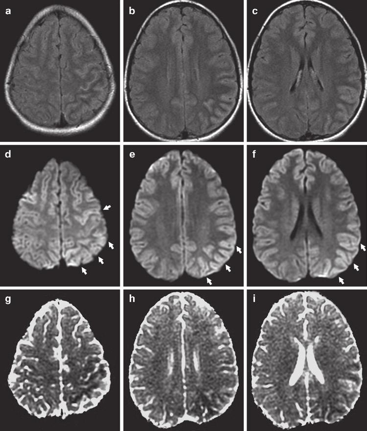 2 Clinical Applications of Diffusion 29 Fig. 2.16 Diffusion changes in a patient with hemiplegic migraine.