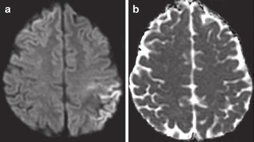 30 R. Forghani and P.W. Schaefer promising tool for evaluation of microstructural changes in epileptic patients and white matter tracts involved in the epileptic network [167, 168].