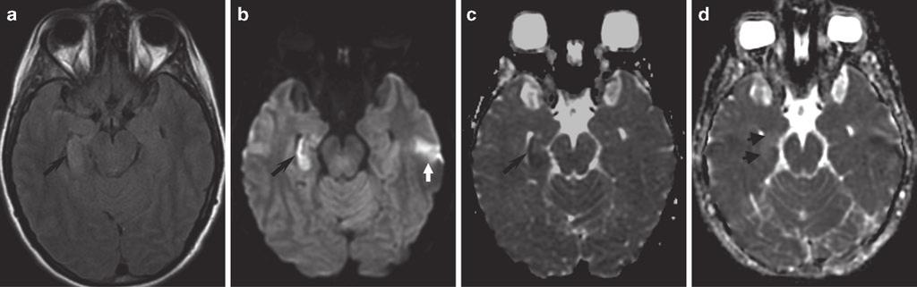 (a) Axial DWI and (b) ADC maps demonstrate cortical and subcortical DWI hyper intensity in the left parietal and posterior frontal lobes with minimal corresponding hyperintensity on the ADC map.