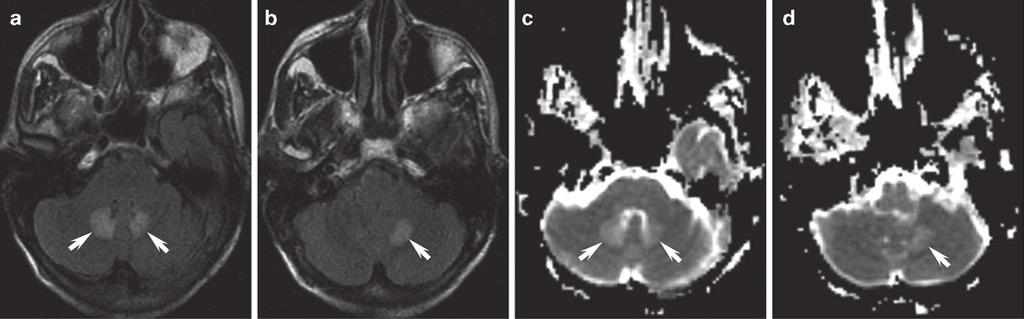 34 Fig. 2.21 Metronidazole-induced encephalopathy. (a, b) Axial FLAIR and (c, d) ADC images demonstrate bilateral symmetric FLAIR hyperintensity involving the cerebellar dentate nuclei.