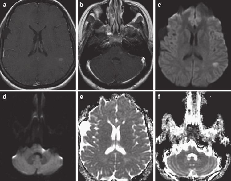 2 Clinical Applications of Diffusion sympathomimetic-induced kaleidoscopic visual illusion syndrome [202], hemolytic uremic syndrome, and high altitude brain injury (Table 2.10).