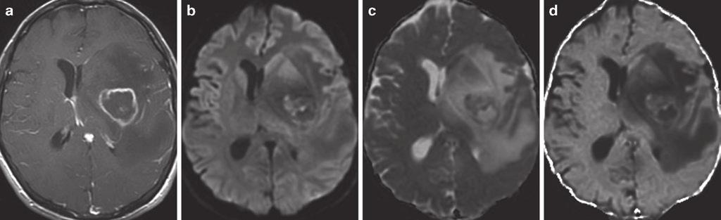 2 Clinical Applications of Diffusion 37 abscesses and extra-axial collections, has been shown to correlate with treatment response clinically [224 227].