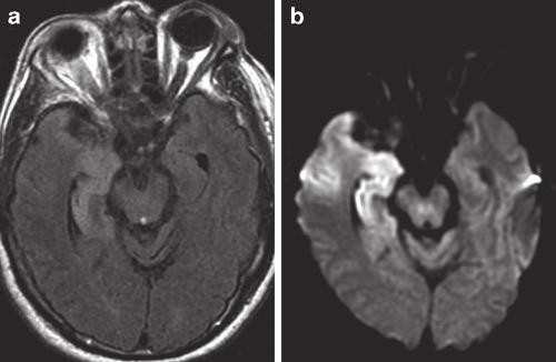 38 R. Forghani and P.W. Schaefer Intraventricular pus, similar to pus within an abscess, has restricted diffusion and is markedly hyperintense on DWI.