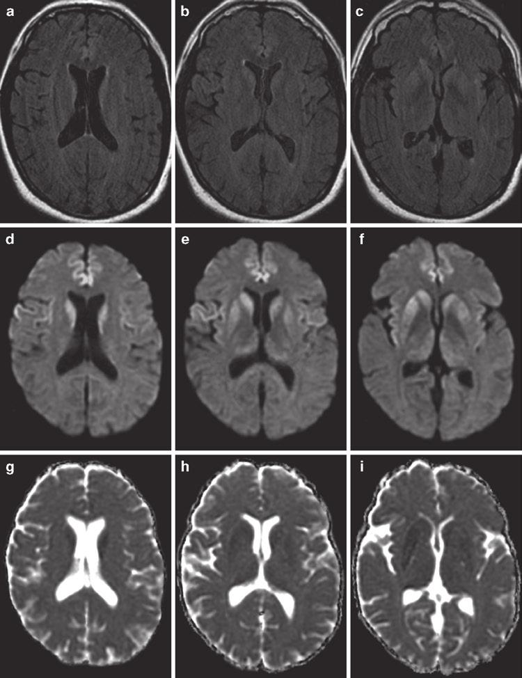 2 Clinical Applications of Diffusion 39 Fig. 2.28 Sporadic CreutzfeldtJacob disease (CJD). (a c) Axial FLAIR, (d f) DWI, and (g i) ADC images are shown.