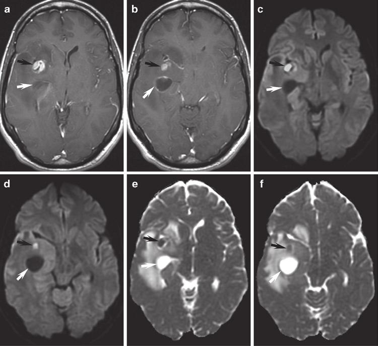 2 Clinical Applications of Diffusion 41 Fig. 2.29 Glioblastoma multiforme.