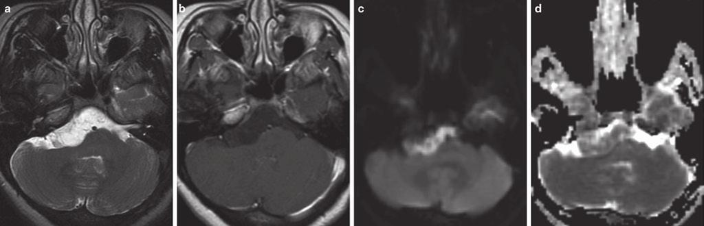 2 Clinical Applications of Diffusion enhancing portion of primary CNS lymphoma have been shown to be associated with shorter disease-free and overall survival [294].
