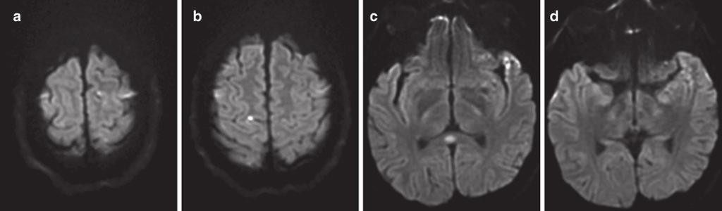 Both arachnoid cysts and epidermoids have signal characteristics similar to CSF and are indistinguishable on T1- and T2-weighted sequences, although epidermoid cysts do have elevated signal compared