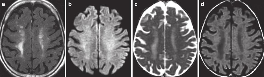 16 Fig. 2.4 T2 shine-through. (a) Axial FLAIR image demonstrates nonspecific periventricular FLAIR hyperintense lesions. (b) On DWI, mildly increased signal raises the possibility of acute ischemia.