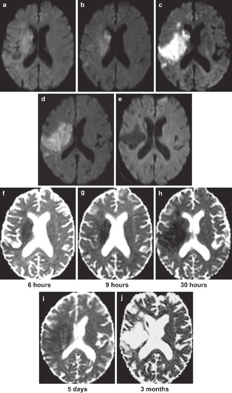 18 Fig. 2.7 Temporal evolution of infarction on diffusion maps. (a e) Axial DWI images and (f j) ADC maps demonstrate the appearance of different infarct stages on diffusion maps.