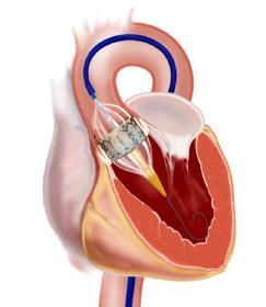 hospitals for TAVI Transcatheter aortic valve Aortic