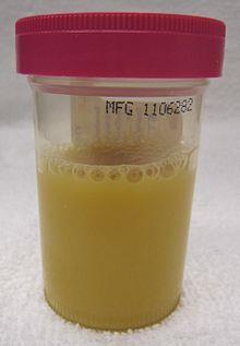 Definition: presence of bacteria >100,000 cfu in urine of an individual without signs or