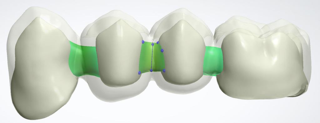 Simple connection to margin line is especially useful if you have the design option in the Dental System Control Panel Automatically connect anatomy set to false.