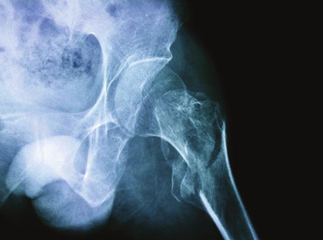 Individualized Fracture Risk What is my risk of breaking a bone?