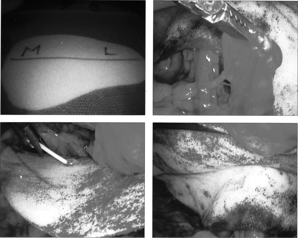 Clockwise from the upper left; the Revive matrix, cut to shape, the reduced hernia sac held on the peritoneal side of the matrix