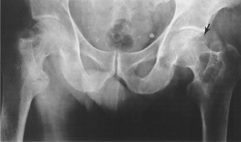 408 PSEUDOCYST OF THE FEMORAL NECK Mayo Clin Proc, May 1987, Vol 62 Fig. 1. Anteroposterior roentgenogram of pelvis of active 66-year-old man with rheumatoid arthritis.