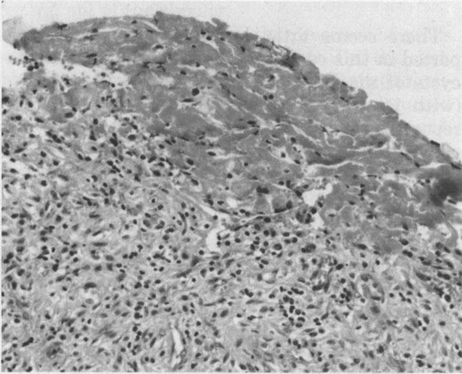 Histologic preparation, showing fibrous tissue infiltrated by round cells and covered by a mass of fibrin. (Hematoxylin and eosin; xl60.) subchondral erosion associated with rheumatoid arthritis.