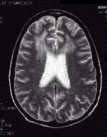AIDS dementia complex (ADC) T2- MRI: Enlargement of ventricles,