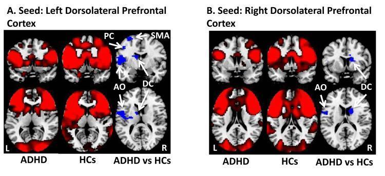 Functional connection: executive Children with ADHD had weaker functional connections between the left dorsolateral prefrontal cortex and the left