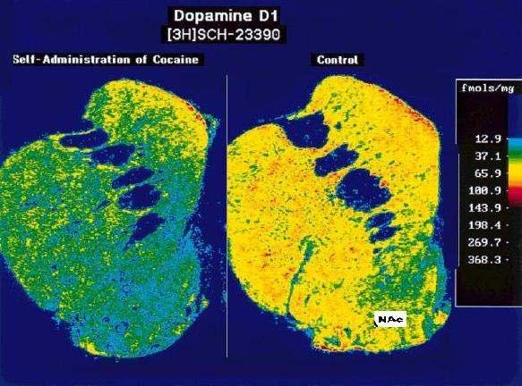 Habitual cocaine users develop tolerance quite quickly One of the mechanisms underlying cocaine tolerance, discovered by Moore et al (1998) Density of dopamine (D1) receptors in nucleus accumbens and