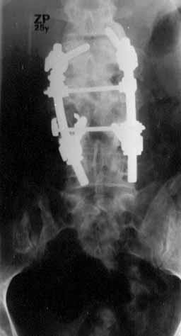 KYPHOTIC DEFORMITY OF THE SPINE 347 A B C D Fig. 2. 22-year-old female patient with posttraumatic kyphosis.