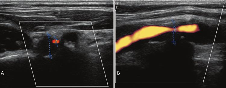 W. Brinjikji et al. Fig. 10. Ultrasonography of the right ICA in transverse (A) and longitudinal (B) planes showing a high-grade stenosis and markedly hypoechoic plaque.