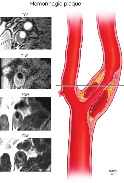 W. Brinjikji et al. Fig. 1. Cross-sectional images of a calcified internal carotid artery (ICA) plaque. Areas of low signal can be seen on TOF, T1-weighted (T1W), PDW, and T2-weighted (T2W) images.