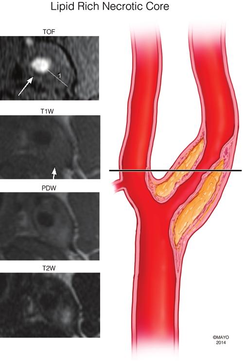 Carotid plaque imaging Fig. 3. Cross-sectional images of an LRNC. PDW and T2-weighted (T2W) images showing hyperintensity.