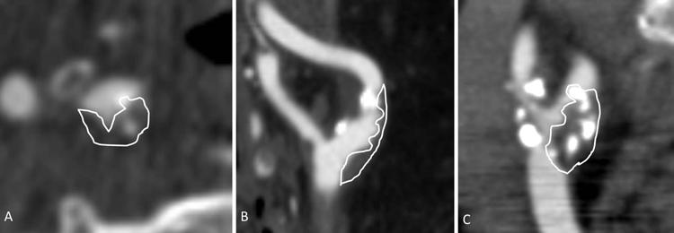 Carotid plaque imaging Fig. 5. MDCTA scans obtained in 3 separate patients with ulcerated plaques. A: Plaque found in a 53-year-old symptomatic male, resulting in a 50% stenosis.
