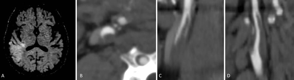W. Brinjikji et al. Fig. 7. Case of a 38-year-old male with sudden-onset, left-sided weakness. A: Axial MR image showing restricted diffusion in the right temporoparietal lobe.
