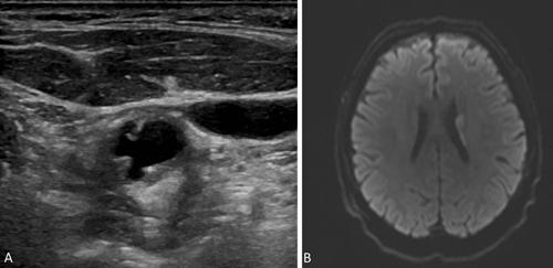 Carotid plaque imaging Fig. 8. Case of a 72-year-old male who presented with aphasia and right-sided weakness.