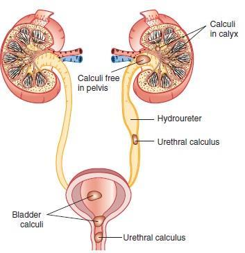 -Renal Calculi: Kidney stones, renal calculi or renal lithiasis (stone formation) are small, hard deposits that form inside your kidneys.