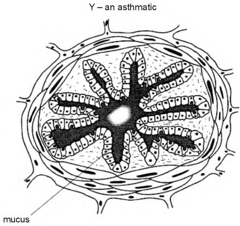 16. The diagram below shows drawings made from cross sections of the upper bronchioles of a non-asthmatic, X, and an asthmatic, Y.