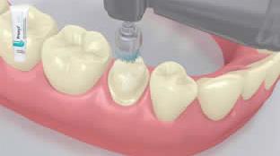Flowchart Multilink Automix TOOTH - Crown - Glass-ceramics - Multilink Automix 1 The temporary is removed The temporary is removed.
