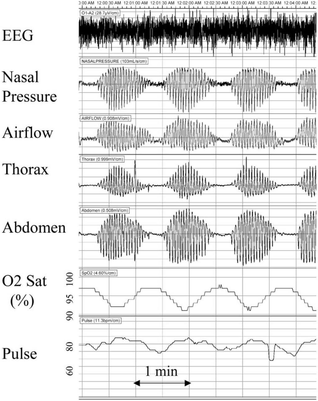 Figure 1. CSR, with crescendo-decrescendo alterations in respiratory effort and airflow, separated by periods of central apnea. There were no arousals during this period.