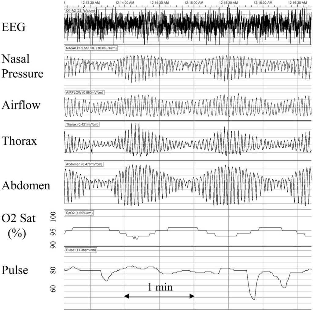 Figure 2. Periodic breathing, with crescendo-decrescendo alterations in respiratory effort and airflow without central apneas. There were no arousals during this period.