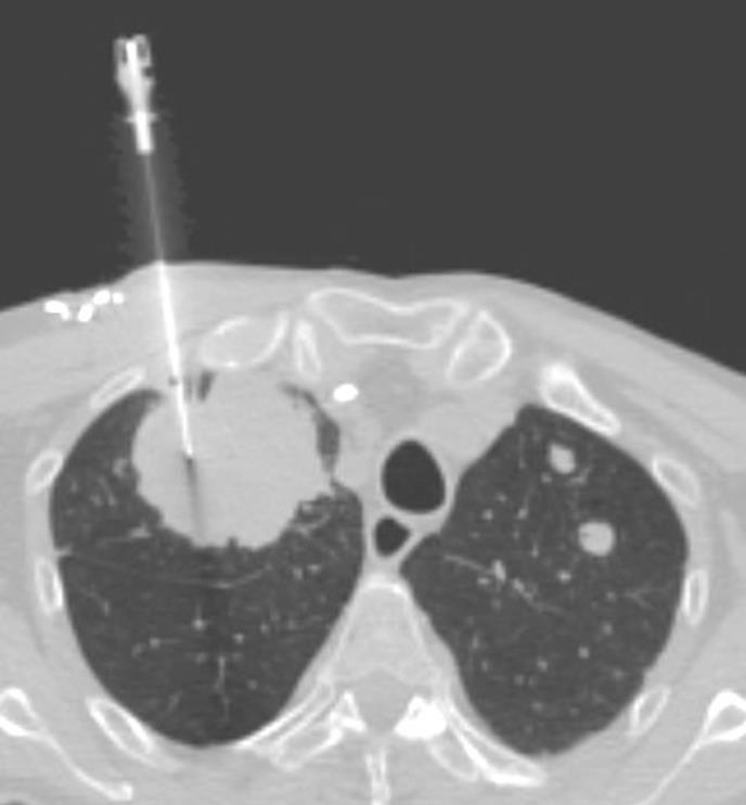 CT guided Biopsy CT is commonly utilized for biopsy Lung, soft tissue, bone Skin entry site identified