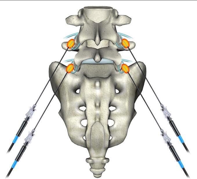 Image-guided Spine Procedures For Relief of Pain Severe Back Pain Facet Joint Selective Nerve Root