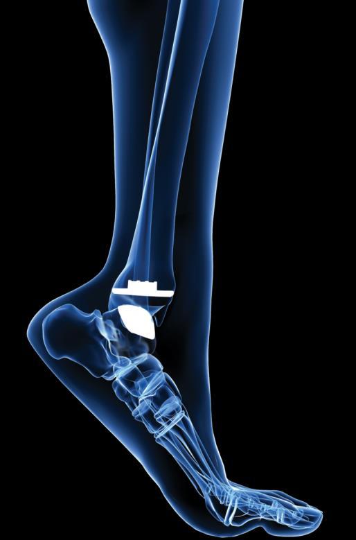 Background & Purpose Satisfactory walking mechanics and patient reported outcomes have been reported following primary TAR 1-4 Takedown of the ankle arthrodesis and conversion to a total ankle