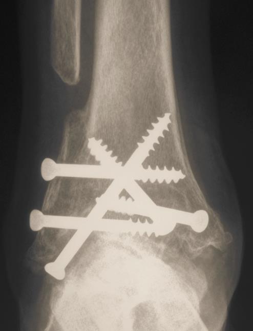 assistive device Bilateral ankle arthritis Diagnosed rheumatoid arthritis Did not