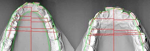 Now open the start lateral ceph and click the VTO button to make the moderate anchorage dental vto. Yours should look similar. If not, review your model measuring dots and archwire placement.